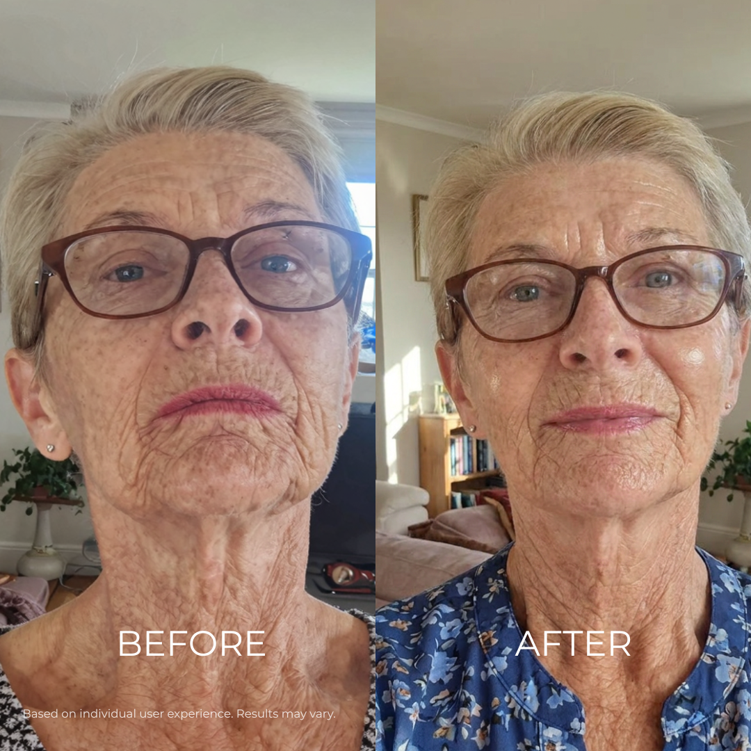 Before and after - Mouth Wrinkles