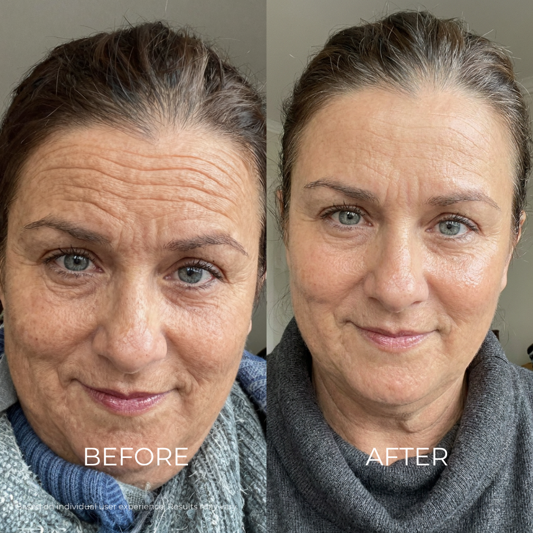 Before and after - Forehead Wrinkles