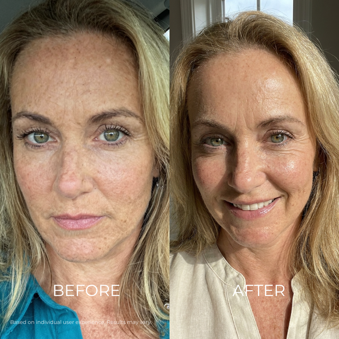 Before and after - Dark Spots